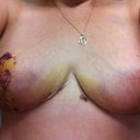 2 Weeks!  Bruising is noticeably getting better :)