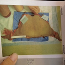 the fat and skin they removed