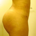 3 weeks post-op
