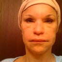 MOST RECENT 1 MO PAST INJ