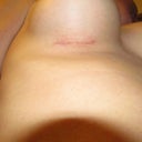 And here's the incision.. not bad at all!!!!