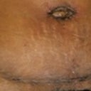 Day 11 - scar healing well