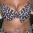 Day 11 - dressings off ... bikini ON!