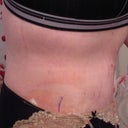 6 days post op