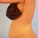 Here's my before surgery pic. I looked like 5 months preggo!