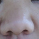 Horrible "before" picture -- this was how bad and huge my nose was