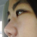 After -- side view -- 3 months