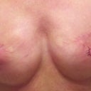 Bilateral Mastectomy with breast and nipple reconstruction; silicone implants.