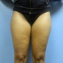 The day of my procedure