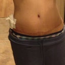 My scar and still dealing with my Seroma. I'm pretty impressed with my scar. It's really low