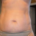 Before Tummy Tuck.