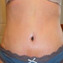 Day 10 after tummy tuck.  Still swollen, but it seems to be getting better.  The stretch marks that use to be above my old belly button are now under the belly button. I guess you can't have everything.
