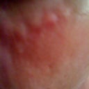 Row of bumps under left eye
