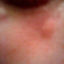 Two bumps under right right. Far corner of eye and far right of under eye
