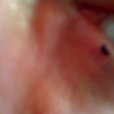 Evolence bumps left side requiring oral prednisone