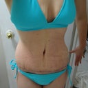 Post Op Week 4