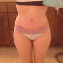 6 weeks postop