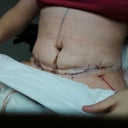day 3 post op garment off for the first time....1st time i saw my belly