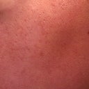 46 HOUR POST-TREATMENT LEFT