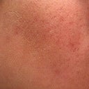 46 hour POST-TREATMENT RIGHT