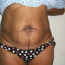 Pre Op2