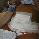 Day 1 Post Op