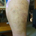 Day 6, Can see the bruise from the bandage