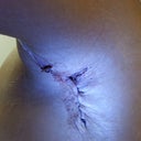 Armpit hole, a little more than one week after getting drains out. Yuuuuck.