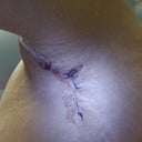 Hole in my armpit, closed up. Phew! That's at about 14 days post-op, I think