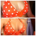 Before and post op day 4