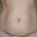 5 days before surgery