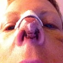 Here is the sutures from the Open part of the proceidure. Does this heal up ok or will I have a big scar?
