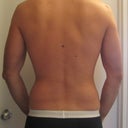 3 Months Post First Procedure