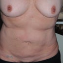Before Surgery