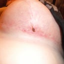 Hole with scab left side day 17
