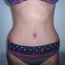 3 weeeks post op