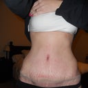 3 weeks post op