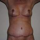 3 weeks post-op