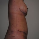 3 weeks post-op