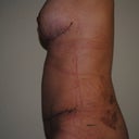 3 weeks post-op