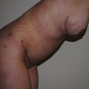 3 weeks post-op
