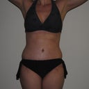 3 weeks post-op