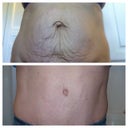 Before and 9 months PO used Pic Stitch app on iphone