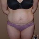 Front view pre-tummy tuck