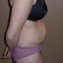 Side view pre-tummy tuck