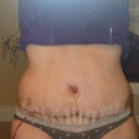 Front view 8 days post op.  Belly button and stomach pretty swollen.