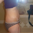 Side view 8 days post op.  Even though I am swollen, I already see a huge difference!