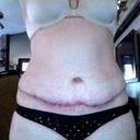 3 weeks after surgery and stitches removed from TT incision and belly button. BB looks normal! Thank goodness!