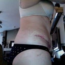 3 weeks after surgery and stitches removed from TT incision and belly button. BB looks normal! Thank goodness!