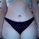 3 weeks after surgery and stitches removed from TT incision and belly button. BB looks normal! Thank goodness!